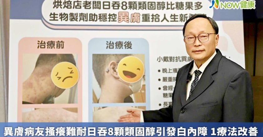 異膚病友搔癢難耐日吞8顆類固醇引發白內障 1療法改善