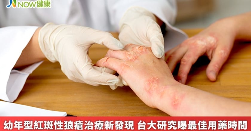 幼年型紅斑性狼瘡治療新發現 台大研究曝最佳用藥時間