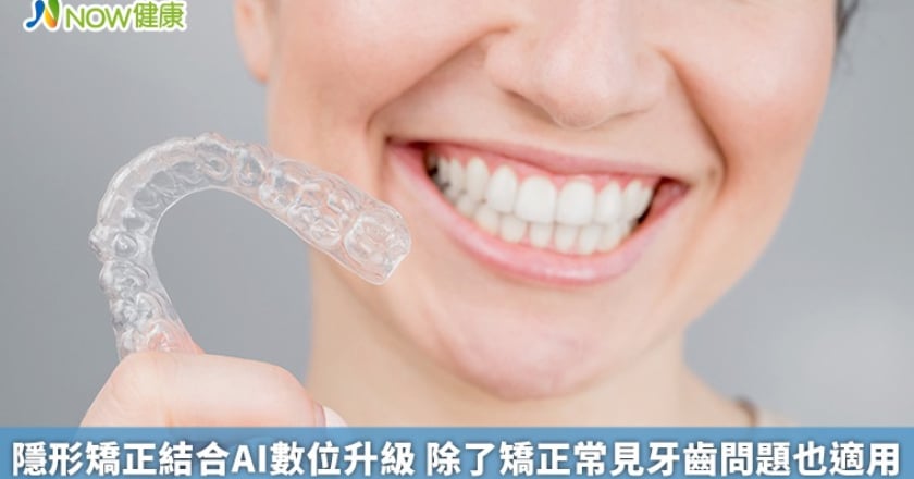 隱形矯正結合AI數位升級 除了矯正常見牙齒問題也適用