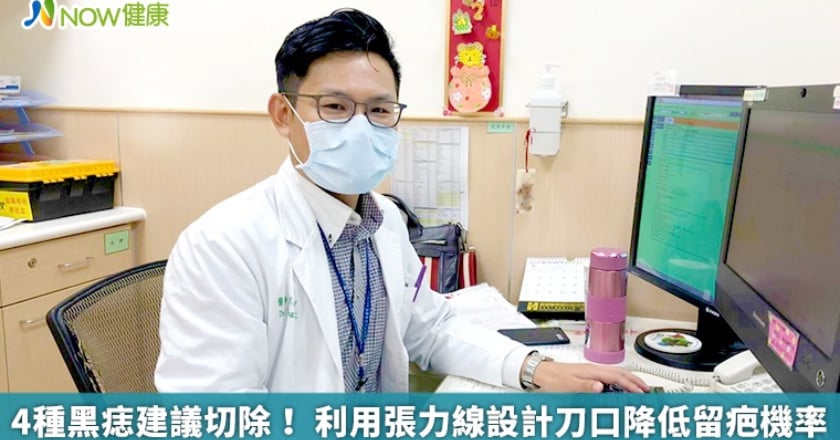 4種黑痣建議切除! 利用張力線設計刀口降低留疤機率