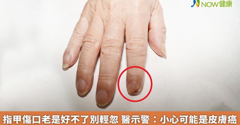 指甲傷口老是好不了別輕忽 醫示警:小心可能是皮膚癌
