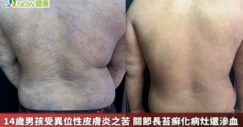 14歲男孩受異位性皮膚炎之苦 關節長苔癬化病灶還滲血