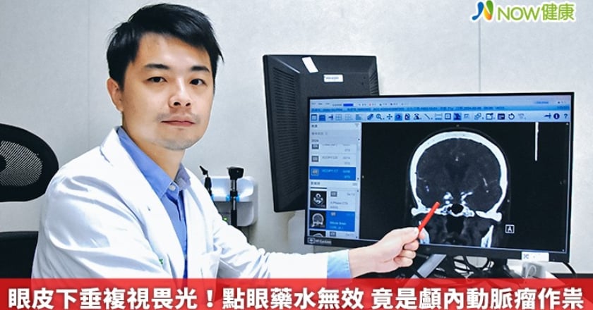 眼皮下垂複視畏光！點眼藥水無效 竟是顱內動脈瘤作祟