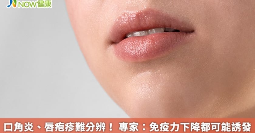 口角炎、唇疱疹難分辨！ 專家：免疫力下降都可能誘發