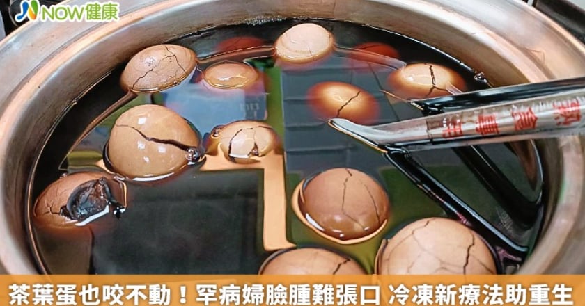 茶葉蛋也咬不動！罕病婦臉腫難張口 冷凍新療法助重生