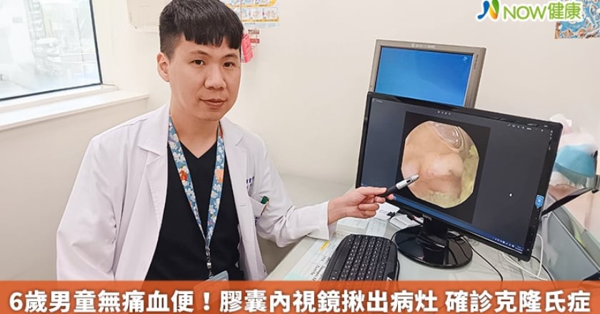 6歲男童無痛血便!膠囊內視鏡揪出病灶 確診克隆氏症