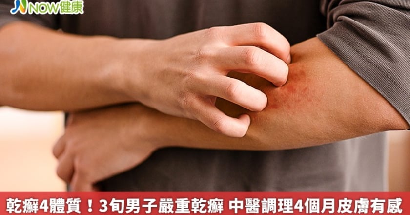乾癬4體質!3旬男子嚴重乾癬 中醫調理4個月皮膚有感
