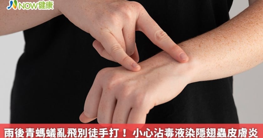 雨後青螞蟻亂飛別徒手打! 小心沾毒液染隱翅蟲皮膚炎