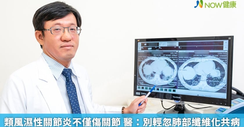 類風濕性關節炎不僅傷關節 醫:別輕忽肺部纖維化共病