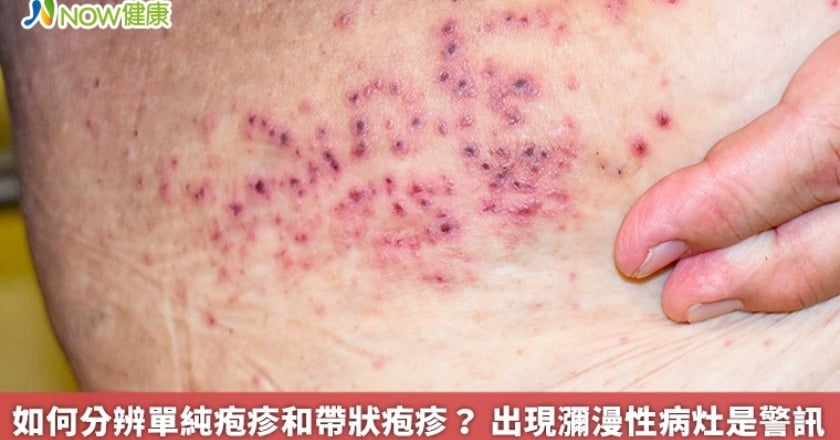 如何分辨單純疱疹和帶狀疱疹？ 出現瀰漫性病灶是警訊