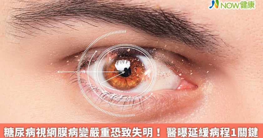 糖尿病視網膜病變嚴重恐致失明！ 醫曝延緩病程1關鍵