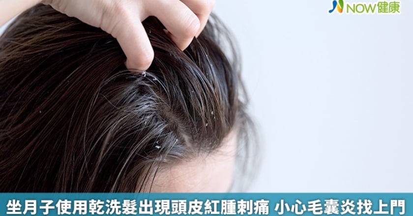 坐月子使用乾洗髮出現頭皮紅腫刺痛 小心毛囊炎找上門