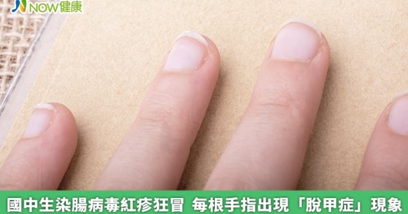 國中生染腸病毒紅疹狂冒 每根手指出現「脫甲症」現象