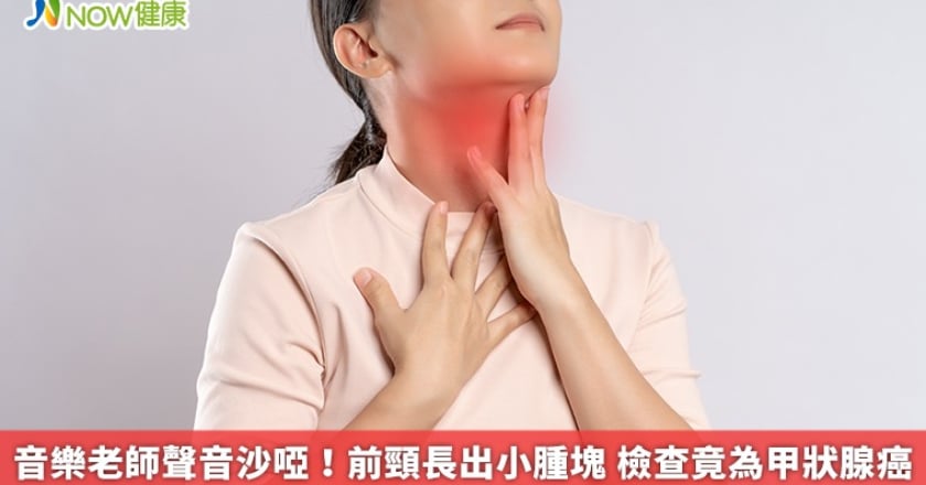 音樂老師聲音沙啞！前頸長出小腫塊 檢查竟為甲狀腺癌