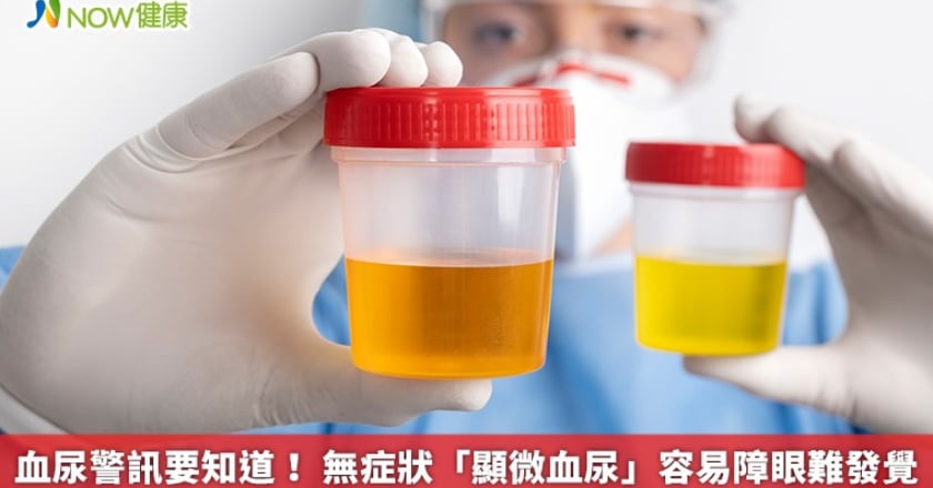 血尿警訊要知道！ 無症狀「顯微血尿」容易障眼難發覺