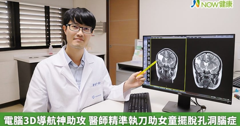電腦3D導航神助攻 醫師精準執刀助女童擺脫孔洞腦症