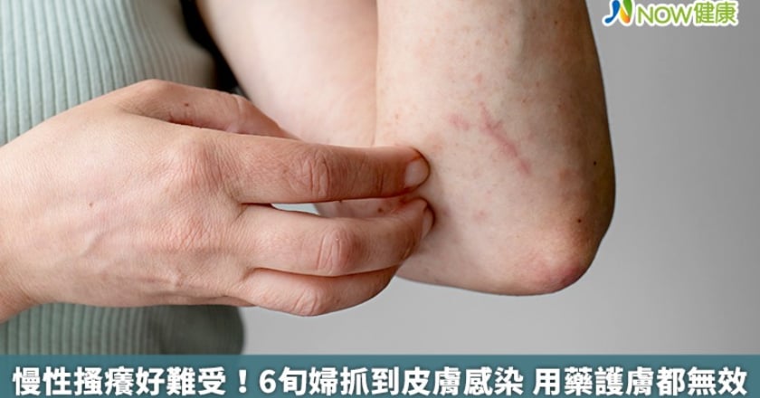 慢性搔癢好難受！6旬婦抓到皮膚感染 用藥護膚都無效