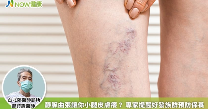 靜脈曲張讓你小腿皮膚癢? 專家提醒好發族群預防保養