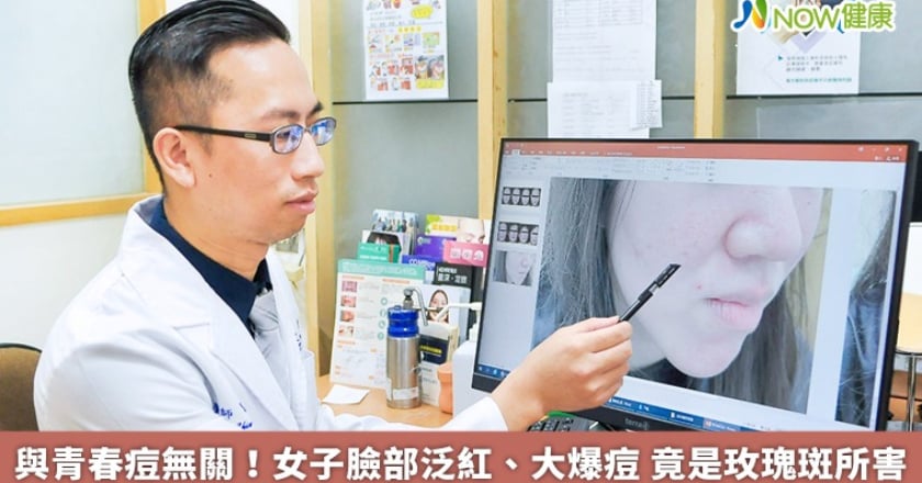 與青春痘無關！女子臉部泛紅、大爆痘 竟是玫瑰斑所害