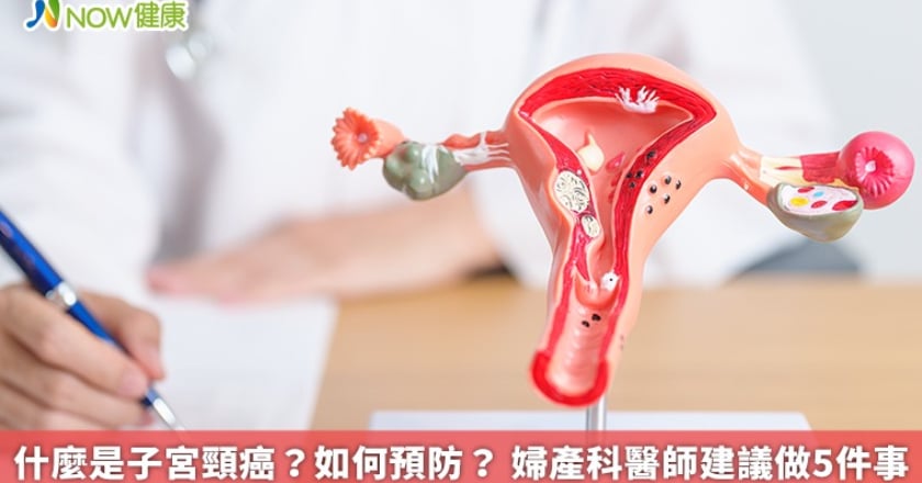 什麼是子宮頸癌?如何預防? 婦產科醫師建議做5件事