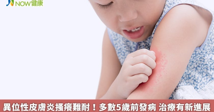 異位性皮膚炎搔癢難耐!多數5歲前發病 治療有新進展