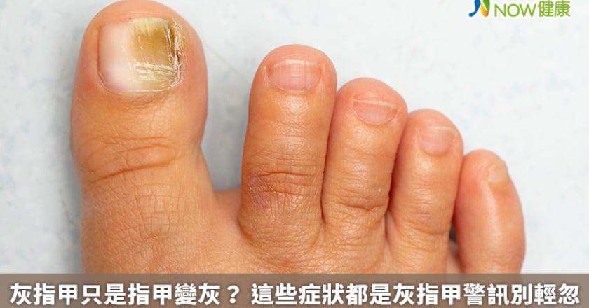 灰指甲只是指甲變灰？ 這些症狀都是灰指甲警訊別輕忽