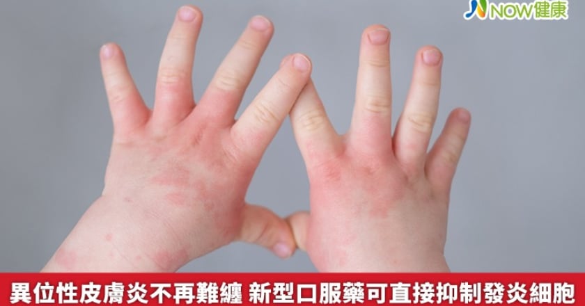 異位性皮膚炎不再難纏 新型口服藥可直接抑制發炎細胞