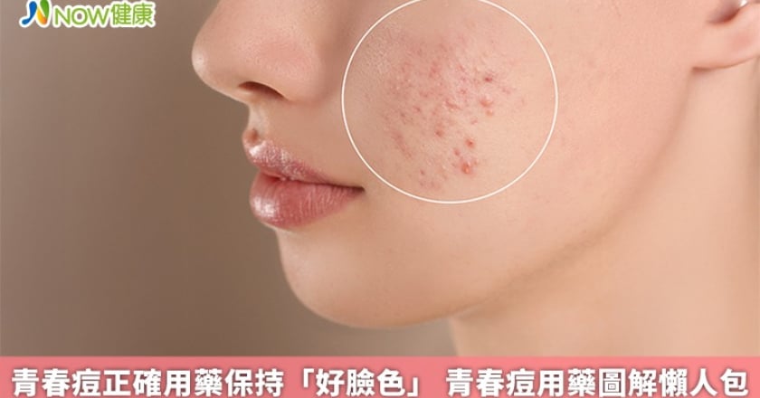 青春痘正確用藥保持「好臉色」 青春痘用藥圖解懶人包
