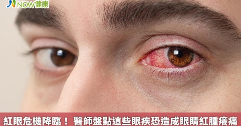 紅眼危機降臨! 醫師盤點這些眼疾恐造成眼睛紅腫癢痛