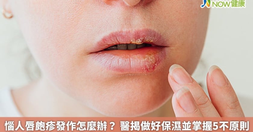 惱人唇皰疹發作怎麼辦? 醫揭做好保濕並掌握5不原則