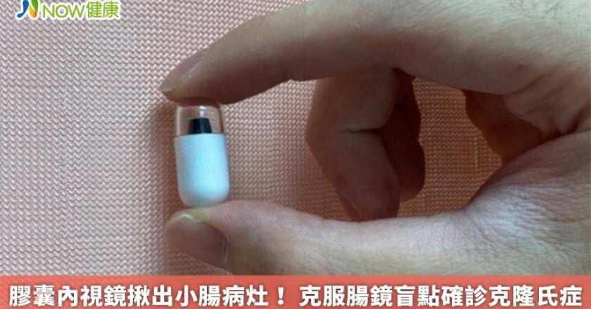膠囊內視鏡揪出小腸病灶! 克服腸鏡盲點確診克隆氏症