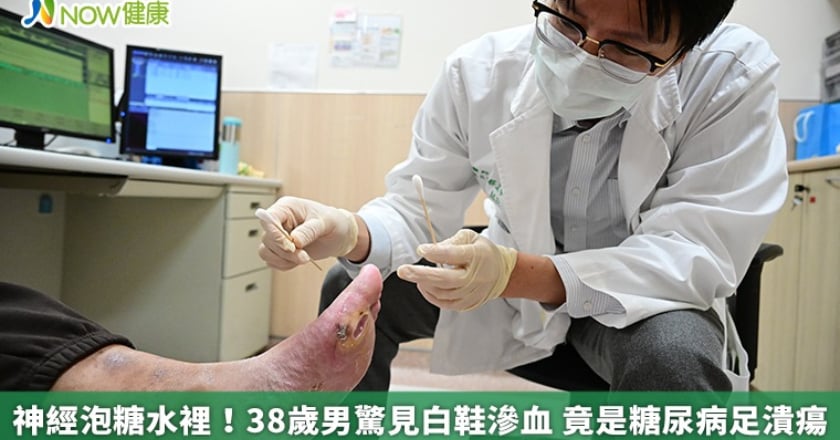 神經泡糖水裡！38歲男驚見白鞋滲血 竟是糖尿病足潰瘍