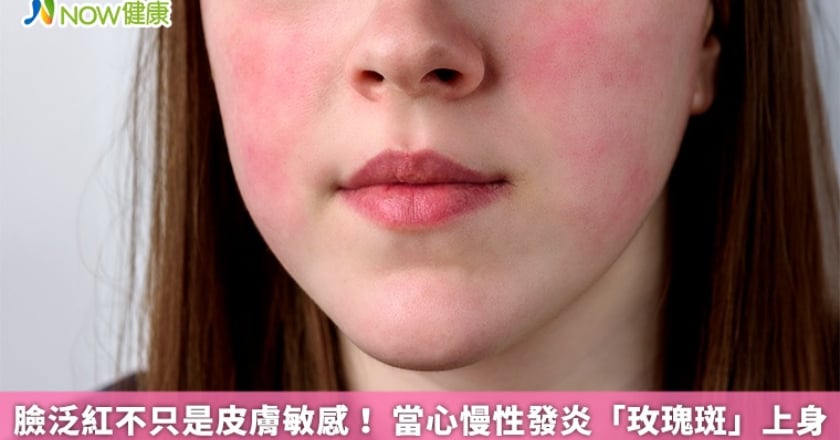 臉泛紅不只是皮膚敏感! 當心慢性發炎「玫瑰斑」上身