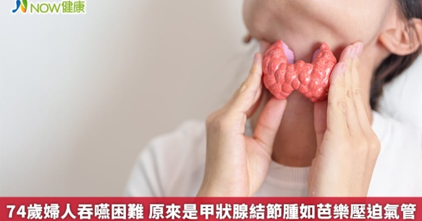 74歲婦人吞嚥困難 原來是甲狀腺結節腫如芭樂壓迫氣管