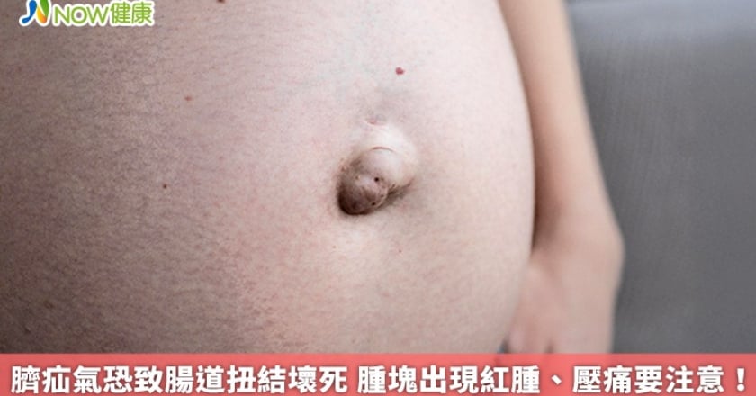 臍疝氣恐致腸道扭結壞死 腫塊出現紅腫、壓痛要注意！