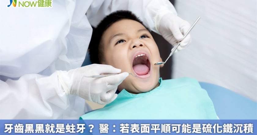 牙齒黑黑就是蛀牙？ 醫：若表面平順可能是硫化鐵沉積
