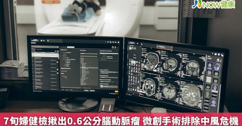 7旬婦健檢揪出0.6公分腦動脈瘤 微創手術排除中風危機