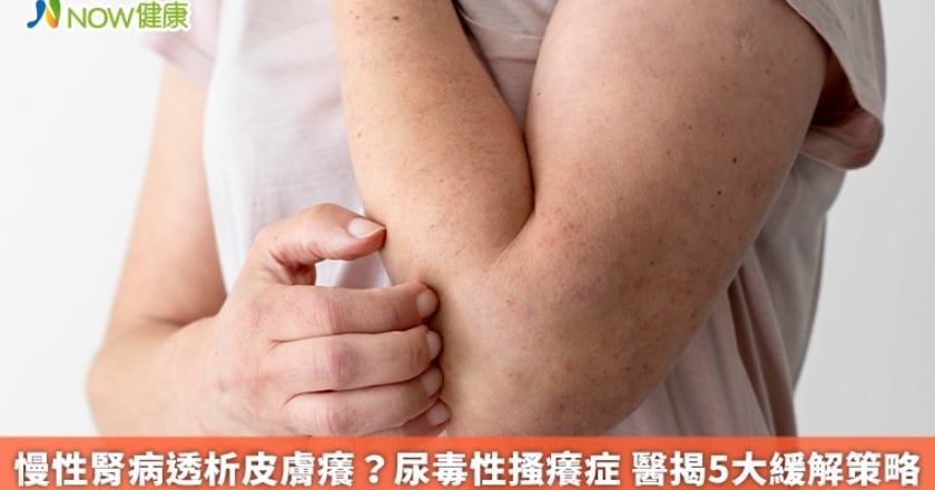 慢性腎病透析皮膚癢？尿毒性搔癢症 醫揭5大緩解策略