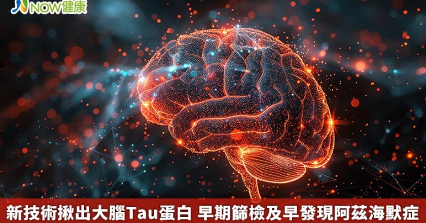 新技術揪出大腦Tau蛋白 早期篩檢及早發現阿茲海默症