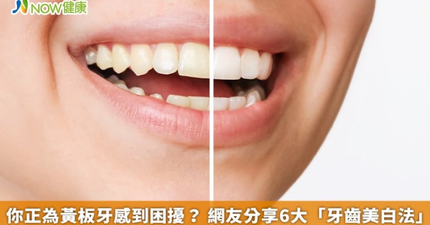 你正為黃板牙感到困擾？ 網友分享6大「牙齒美白法」