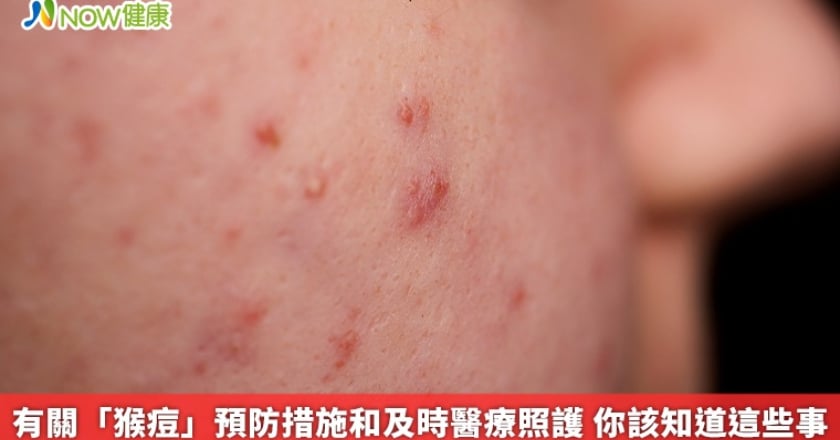 有關「猴痘」預防措施和及時醫療照護 你該知道這些事