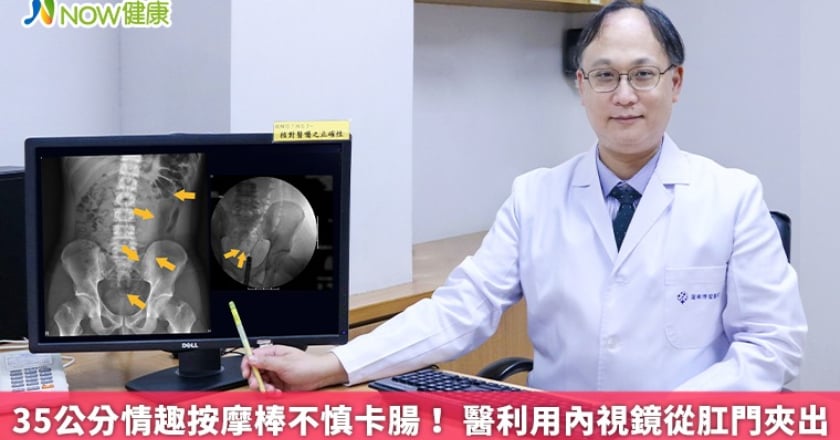 35公分情趣按摩棒不慎卡腸！ 醫利用內視鏡從肛門夾出