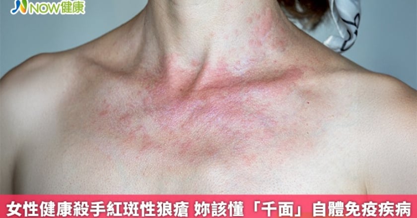 女性健康殺手紅斑性狼瘡 妳該懂「千面」自體免疫疾病