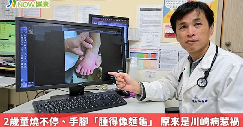 2歲童燒不停、手腳「腫得像麵龜」 原來是川崎病惹禍