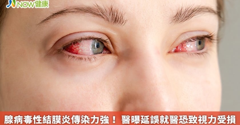 腺病毒性結膜炎傳染力強！ 醫曝延誤就醫恐致視力受損