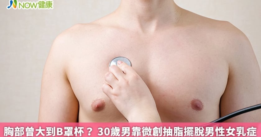 胸部曾大到B罩杯？ 30歲男靠微創抽脂擺脫男性女乳症