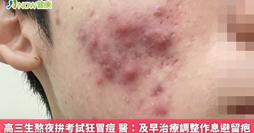高三生熬夜拚考試狂冒痘 醫：及早治療調整作息避留疤