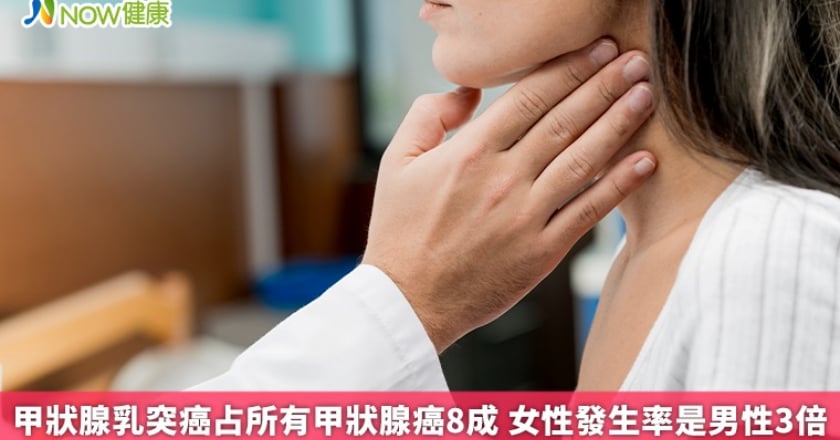 甲狀腺乳突癌占所有甲狀腺癌8成 女性發生率是男性3倍