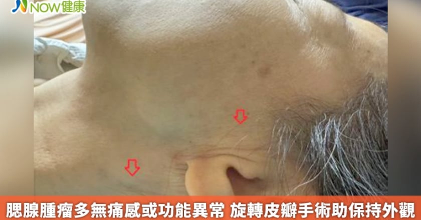 腮腺腫瘤多無痛感或功能異常 旋轉皮瓣手術助保持外觀