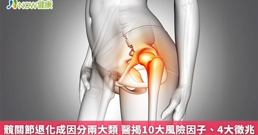 髖關節退化成因分兩大類 醫揭10大風險因子、4大徵兆